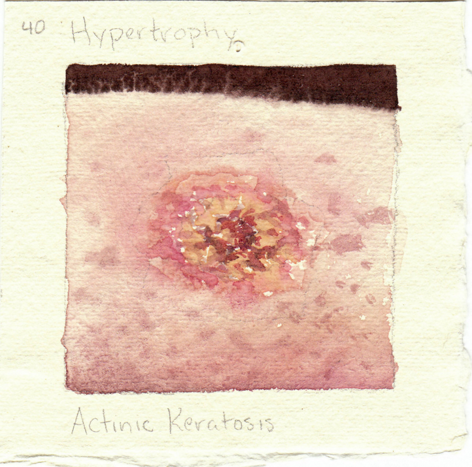 actinic_keratosis.jpg