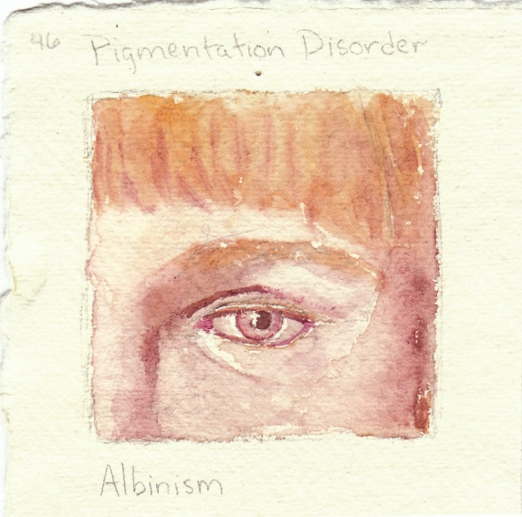 albinism.jpg