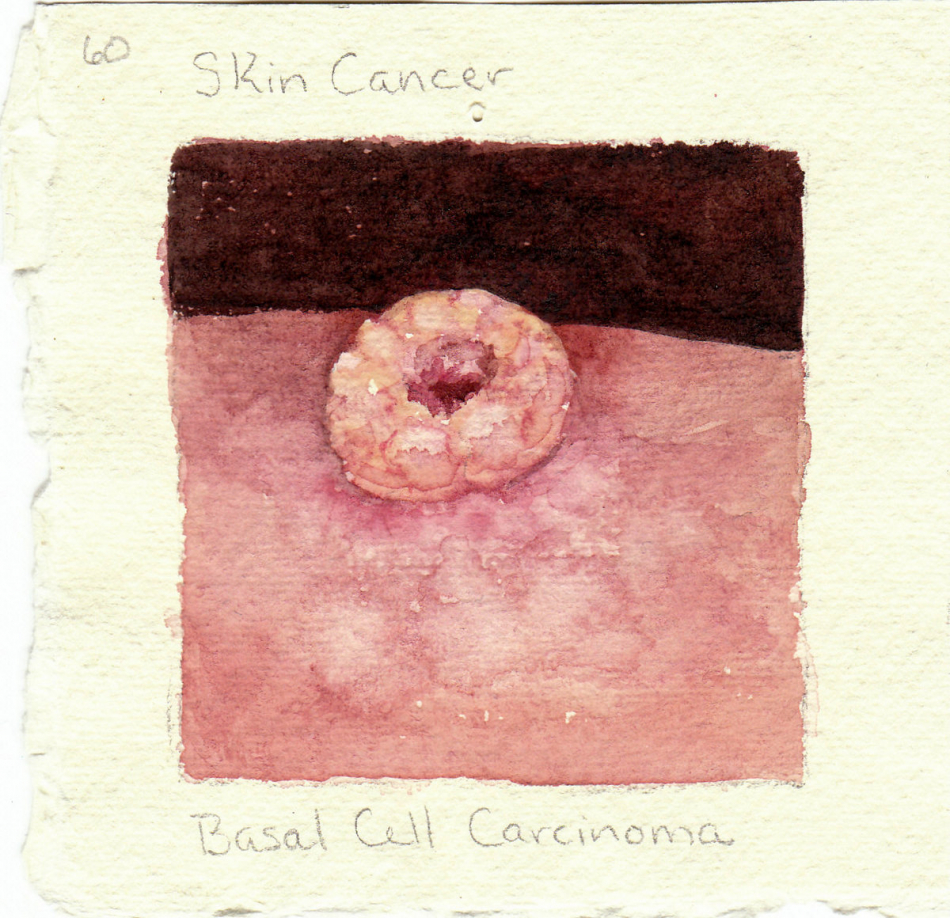 basal_cell_carcinoma.jpg