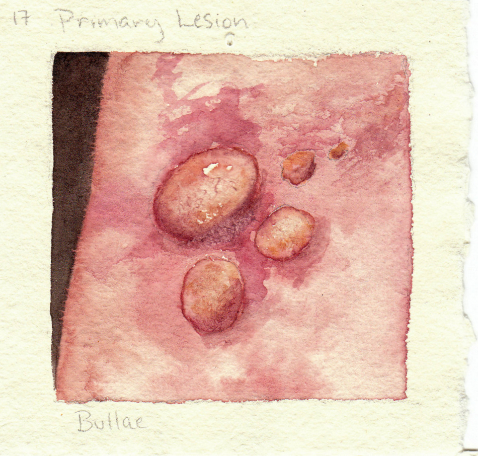 bullae.jpg
