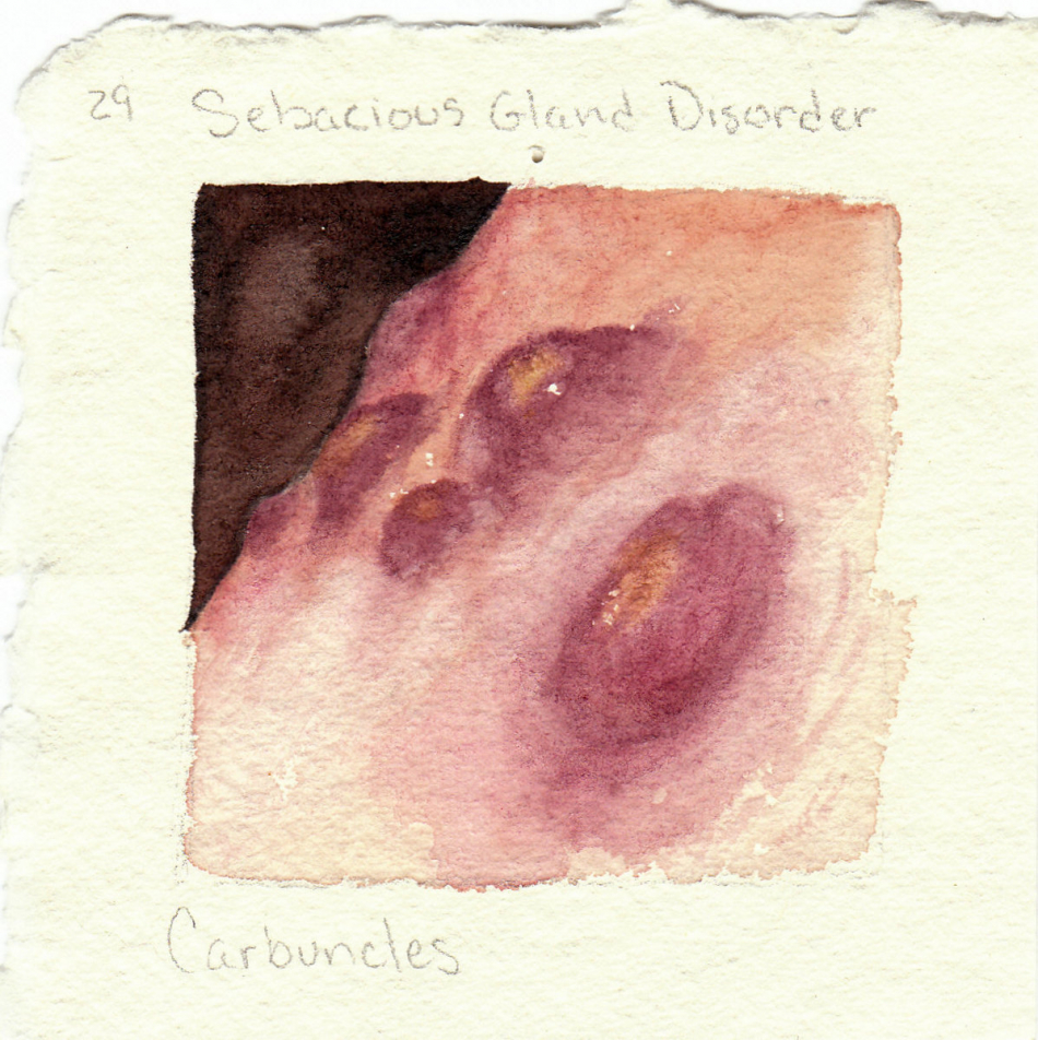carbuncles.jpg