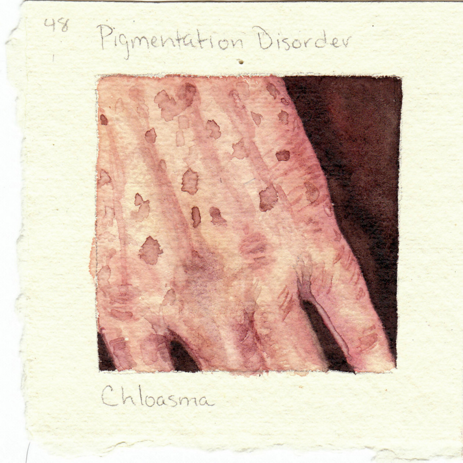 chloasma.jpg