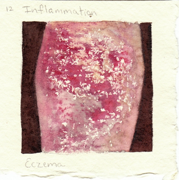 eczema.jpg