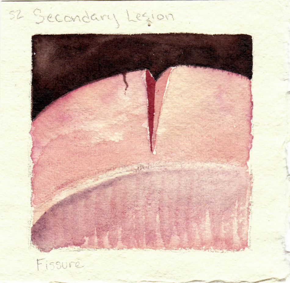 fissure.jpg