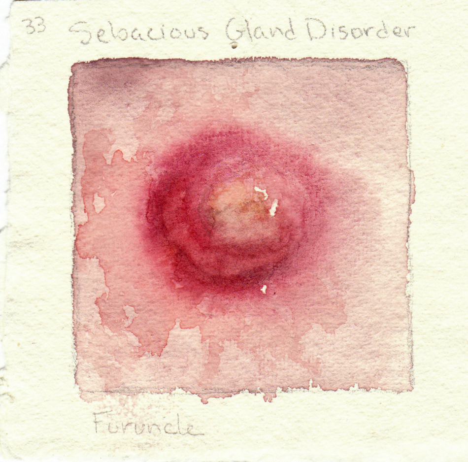 furuncle.jpg