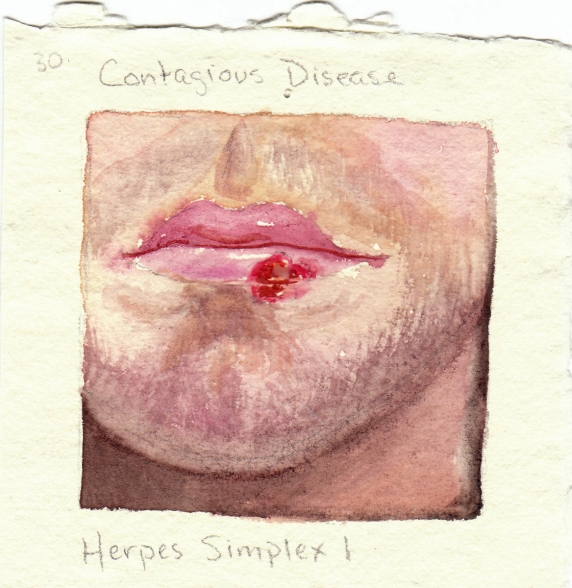 herpes_simplex1.jpg