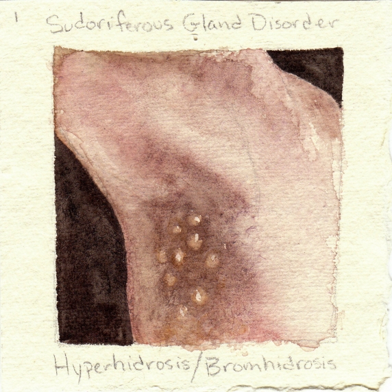 hyperhidrosis.jpg
