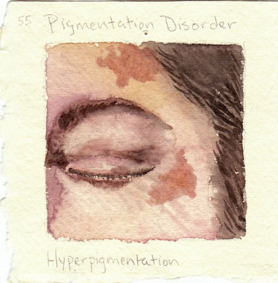 hyperpigmentation.jpg