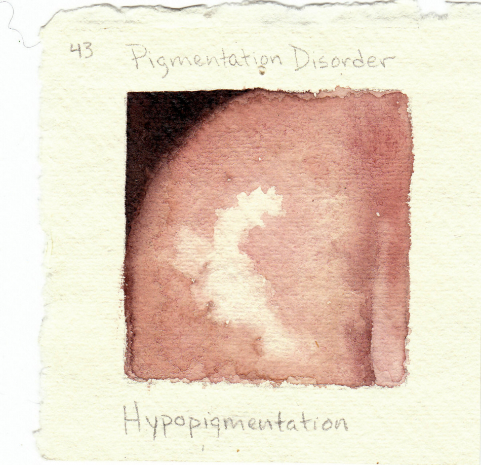 hypopigmentation.jpg