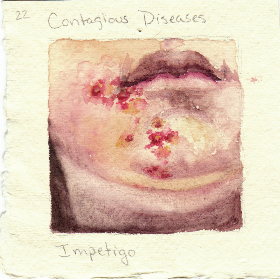 impetigo.jpg
