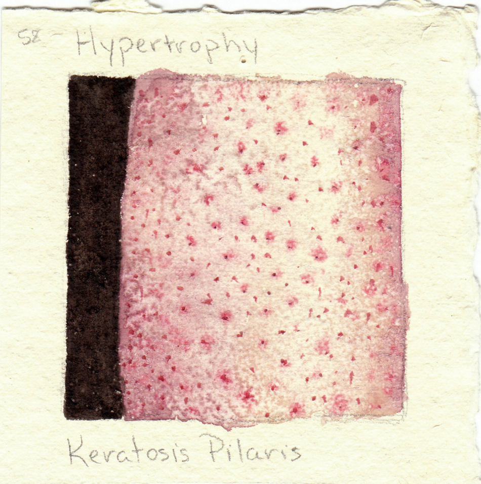 keratosis_pilaris.jpg