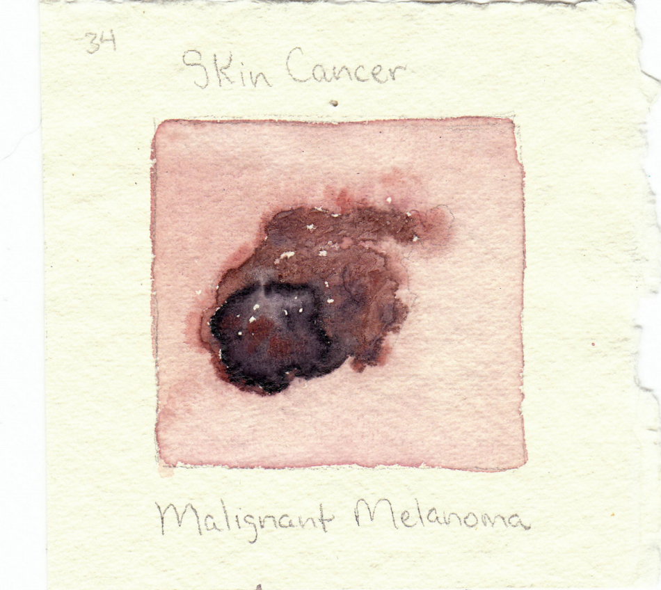 malignant_melanoma.jpg