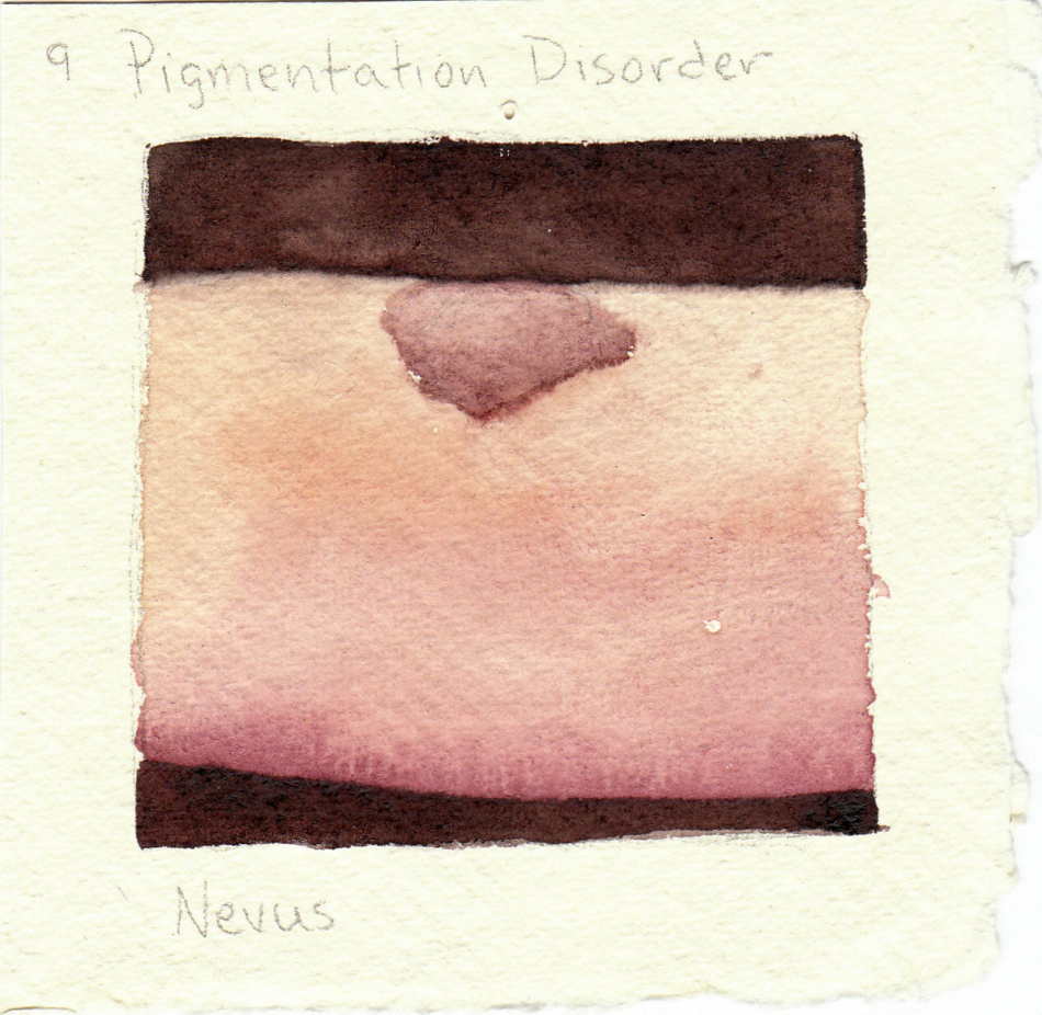 nevus.jpg