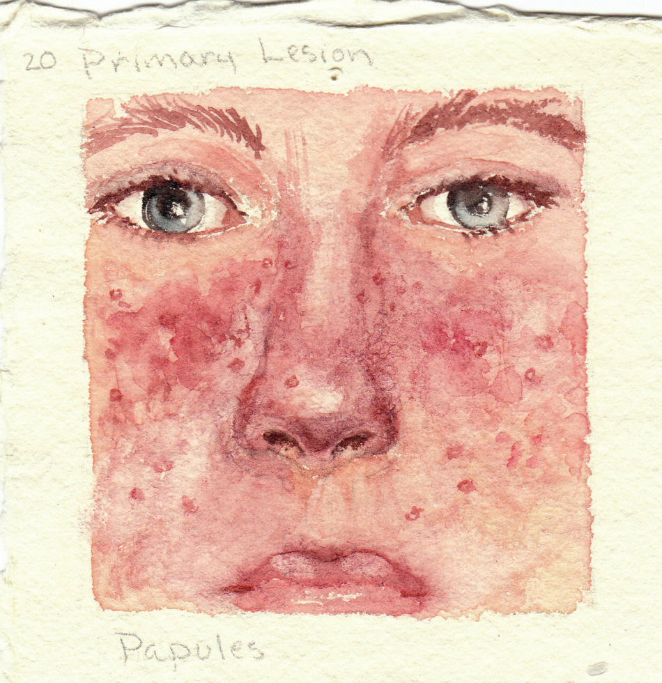 papules.jpg