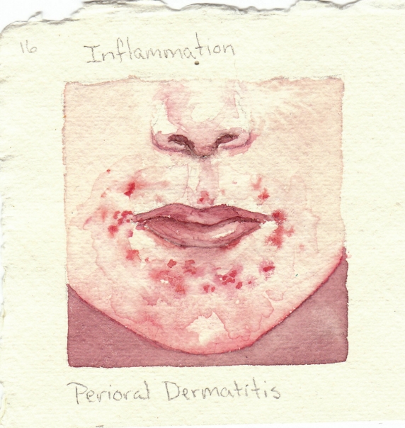 perioral_dermatitis.jpg