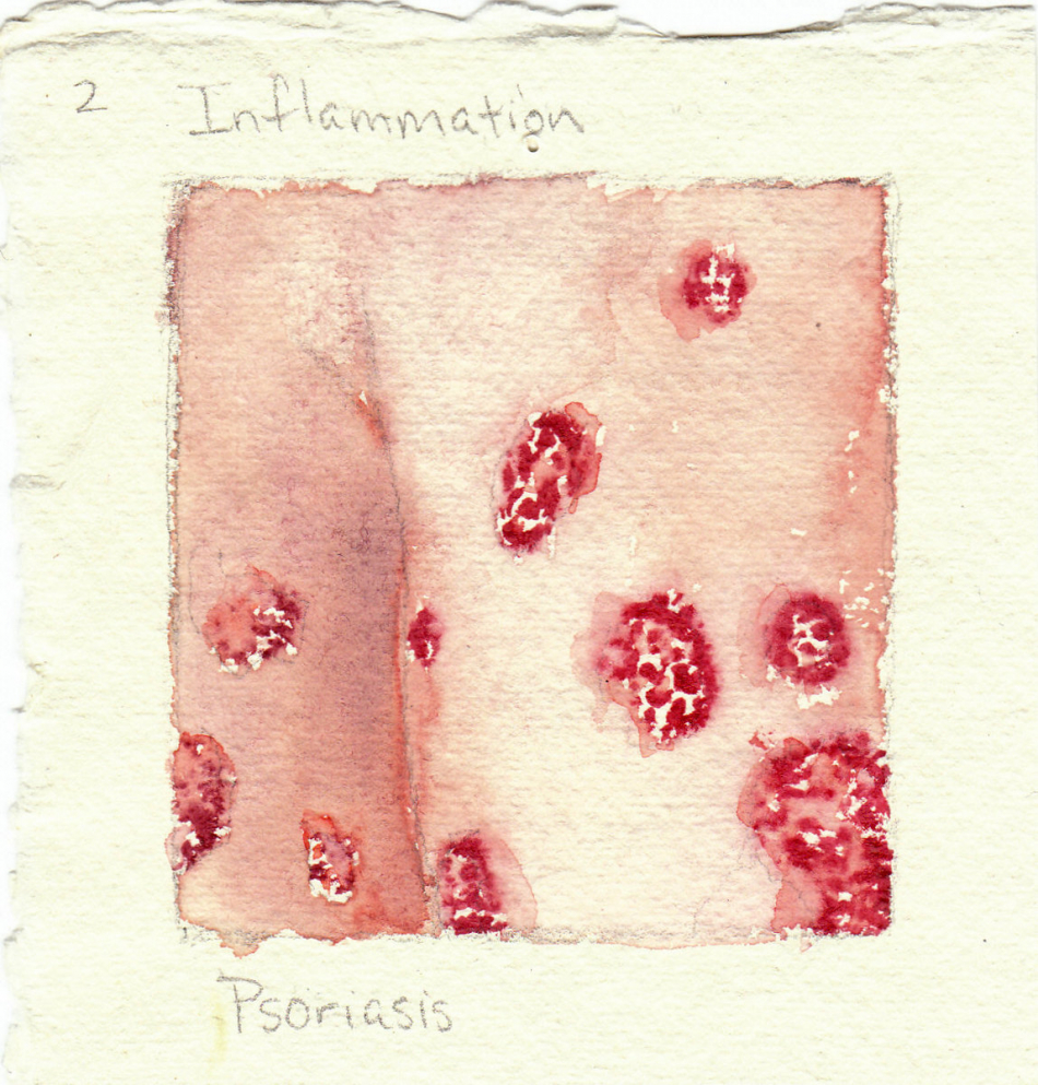 psoriasis.jpg