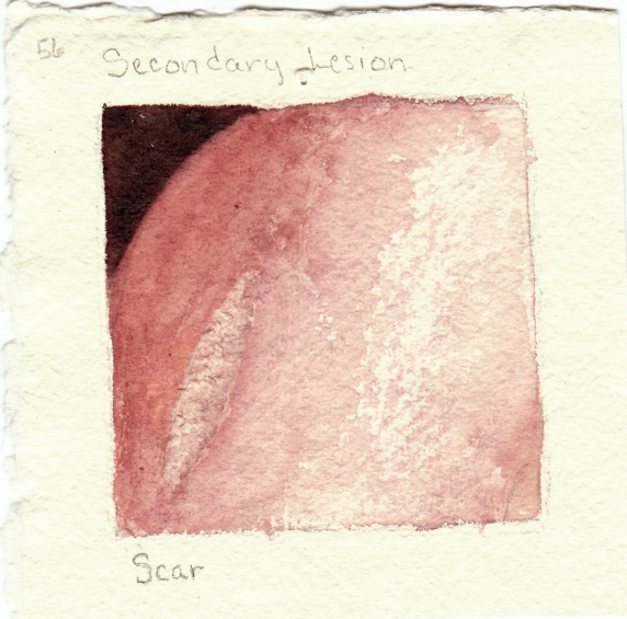 scar.jpg