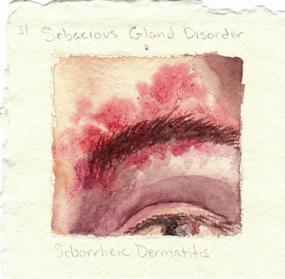 seborrheic_dermatitis.jpg