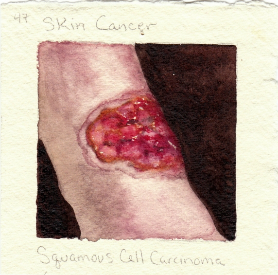 squamous_cell_carcinoma.jpg