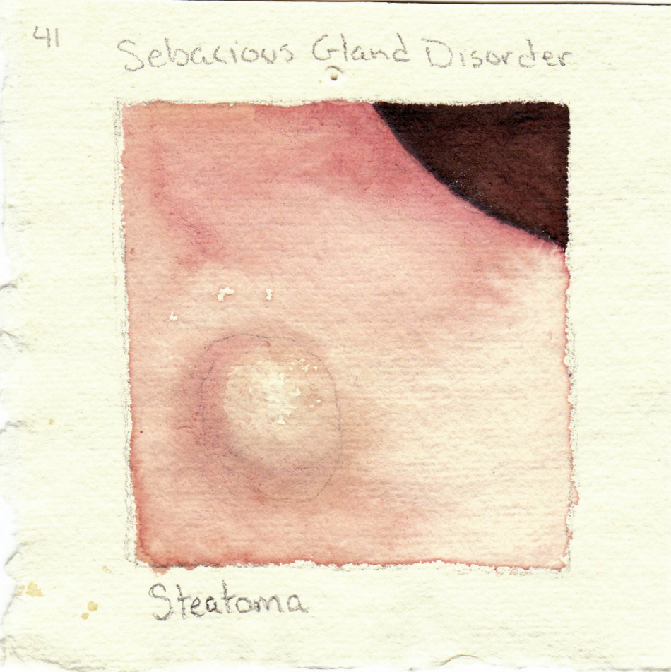 steatoma.jpg