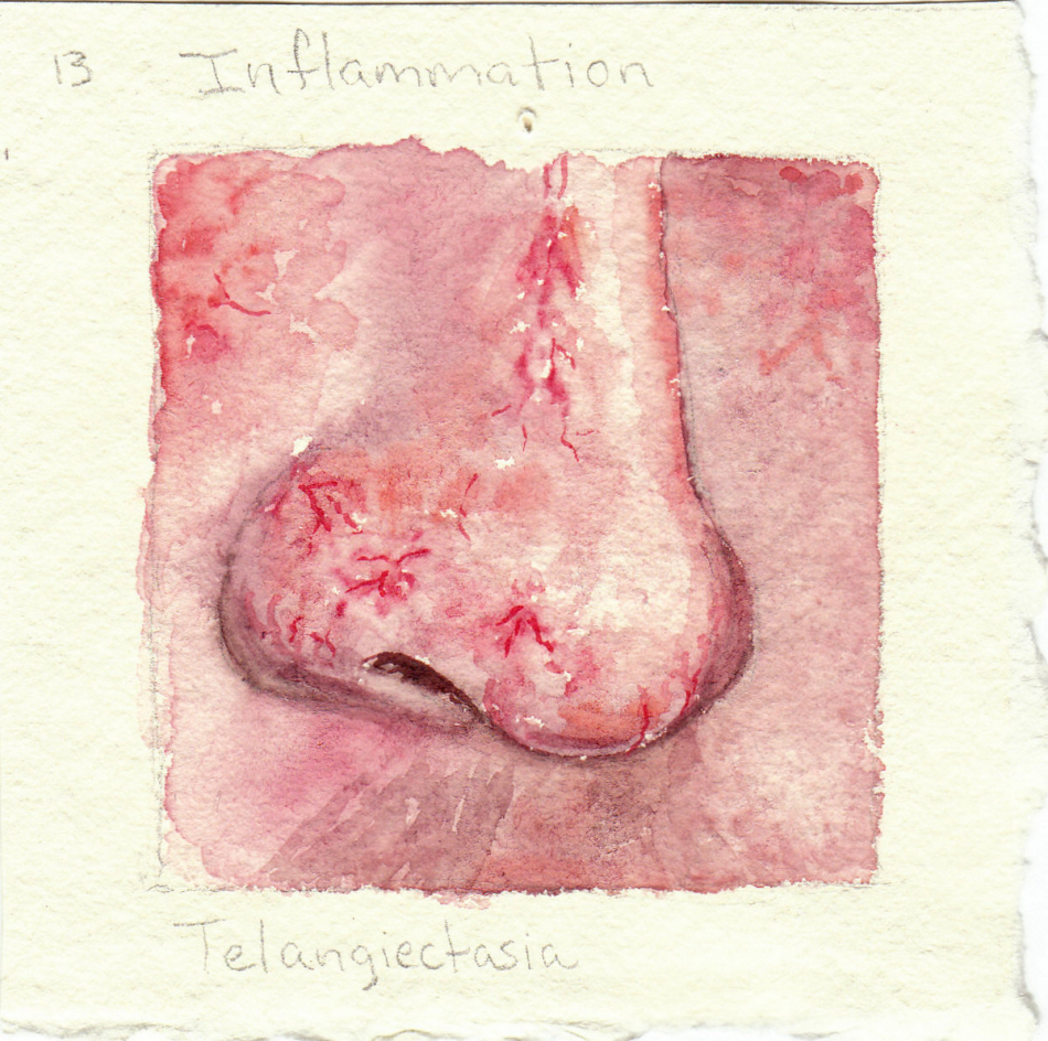 telangiectasia.jpg