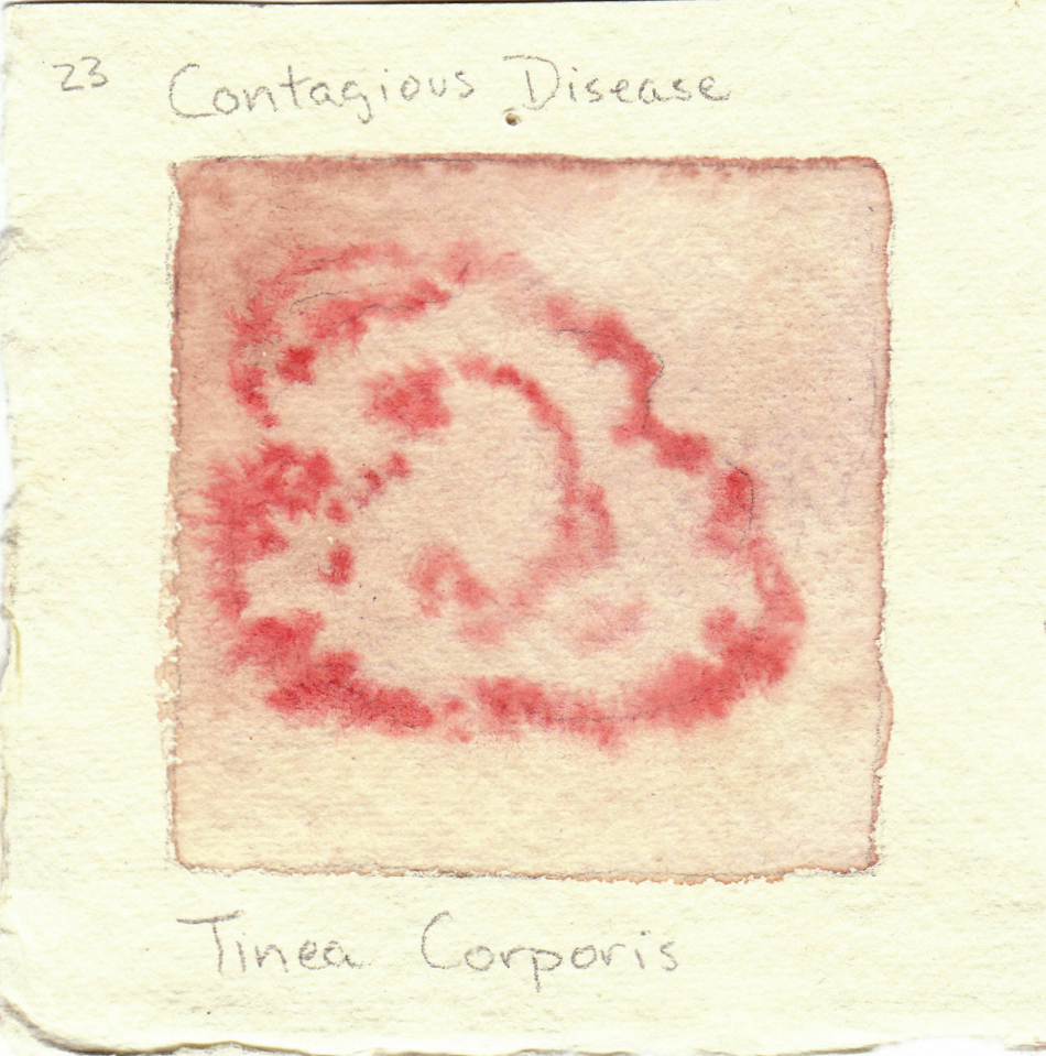 tinea_corporis.jpg