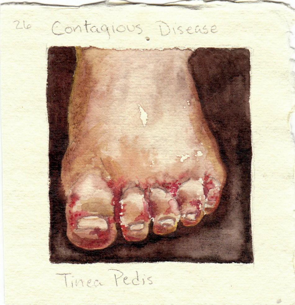 tinea_pedis.jpg