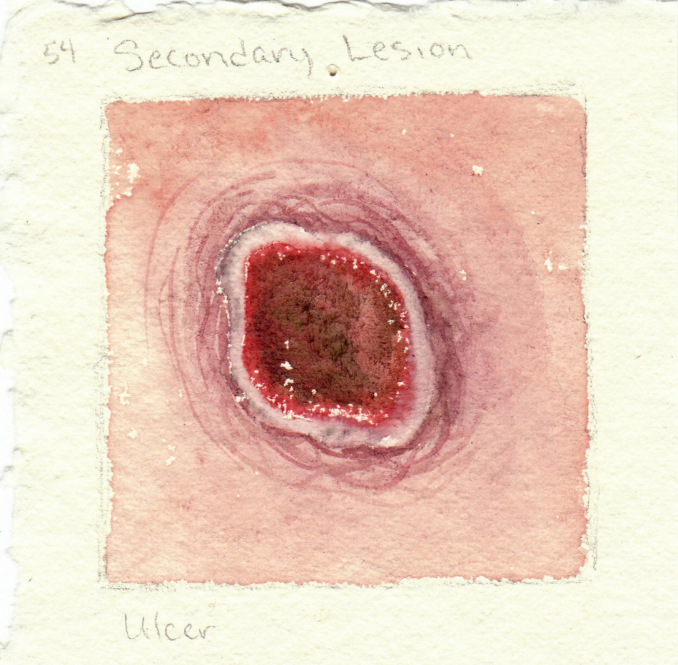 ulcer.jpg
