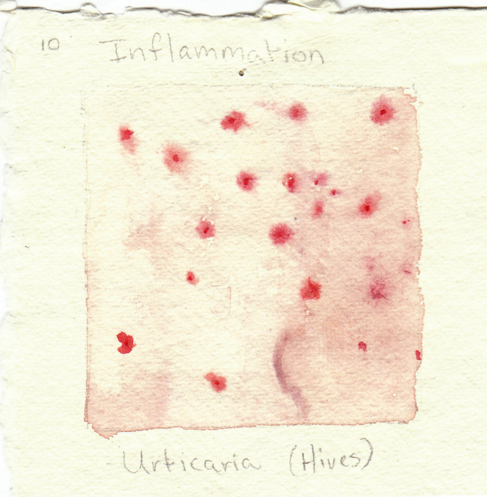 urticaria.jpg