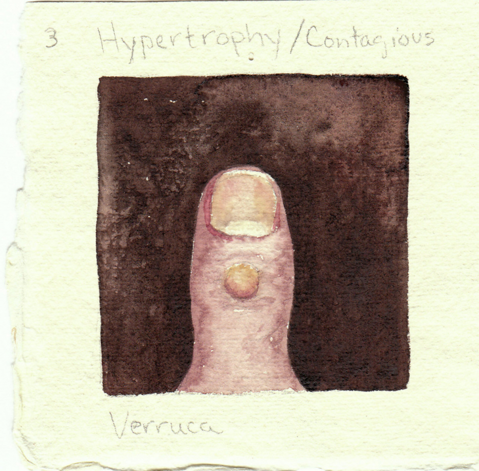 verruca.jpg
