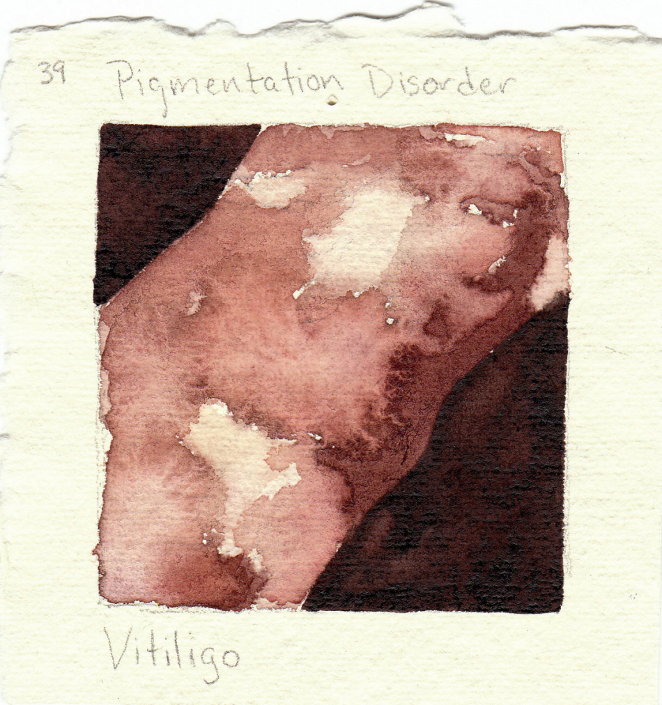 vitiligo.jpg