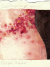 Herpes Zoster herpes_zoster.jpg
